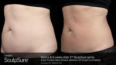 Sculpsure Before and after Treatment | Prestige Physicians | Fort Lauderdale FL