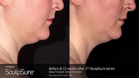 Sculpsure Before and after Treatment | Prestige Physicians | Fort Lauderdale FL